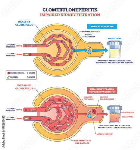 Glomerulonephritis impaired kidney filtration contrasts healthy vs inflamed glomerulus, Bowmans capsule, and urine sample to show leakage, proteinuria, and hematuria. Outline diagram