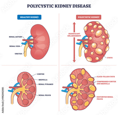 Polycystic kidney disease diagram shows enlarged kidney with fluid-filled cysts, comparing healthy vs PKD, highlights cortex, medulla, renal pelvis. Outline diagram