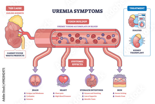 Uremia symptoms diagram visualizes failing kidneys causing toxin buildup in blood and systemic effects, key objects, kidney, blood vessel, organs. Outline diagram