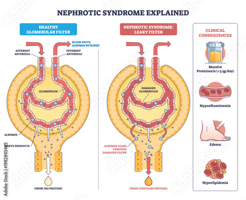 Nephrotic syndrome overview, side-by-side glomeruli show healthy vs leaky filter leading to proteinuria, key objects, glomerulus, albumin leak, urine drop. Outline diagram