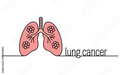 An illustration of lungs with cancer cells growing inside them.