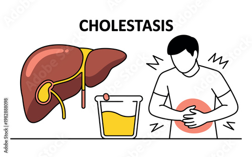 An illustration depicting cholestasis with a liver, bile, and a person experiencing abdominal pain.