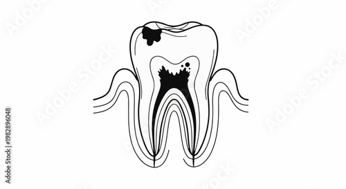 Stylized cross-section of a human tooth with cavities and decay