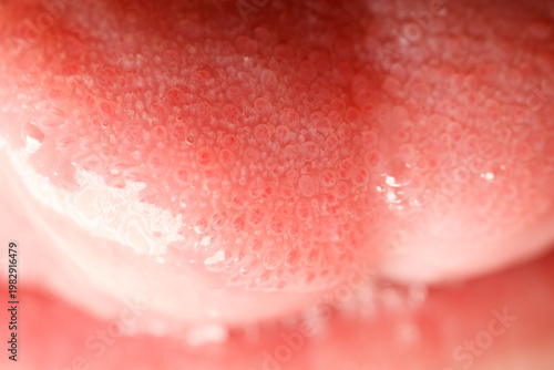 A red tongue with white spots