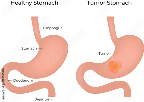 Healthy and Tumor Stomach Medical Illustration
