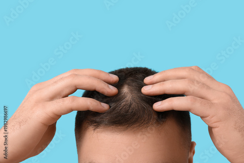 Young man with hair loss pr...
