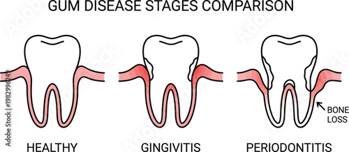 Gum disease stages comparison infographic medical line art vector illustration