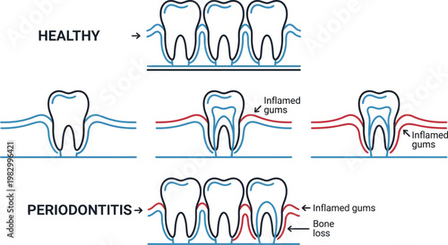 Periodontitis gum disease stages medical line art vector illustration