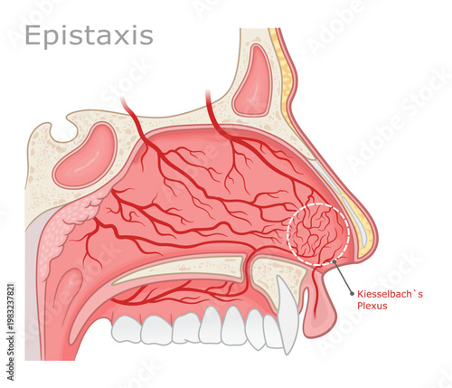 Causes of Nosebleeds: Diagram of Kiesselbach's Area and Arterial Network in the Nasal Cavity. ENT Series.