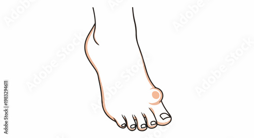 Cartoon illustration of a human foot with a bunion on the big toe