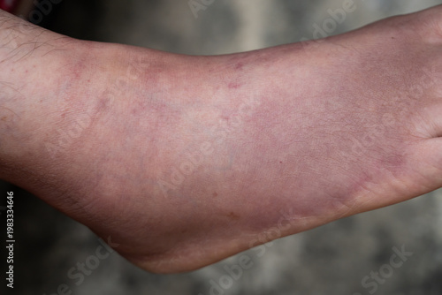 Swollen Foot After Cast Removal of Metatarsal Fracture