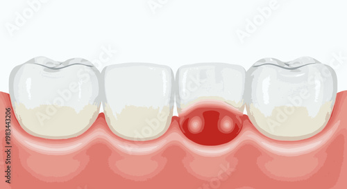 Medical 3D illustration of inflamed red gums around a molar tooth showing gingivitis or periodontal disease symptoms. Accurate anatomical dental health concept for hygiene and oral care education.