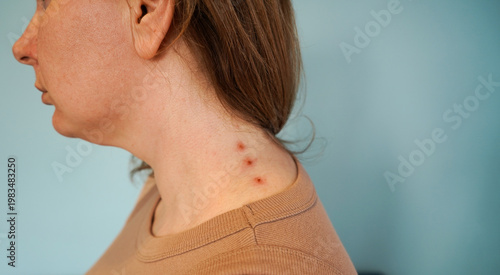 Fotografie Woman with inflamed acne on her neck and jawline area