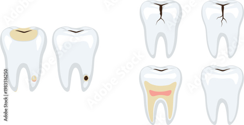 Tooth Decay and Damage Illustration Set with Cavities Cracks Enamel Erosion and Internal Structure Dental Health Medical Vector Collection