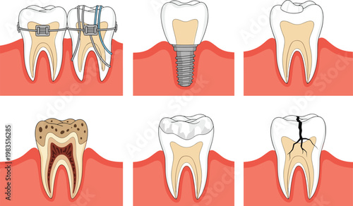 Dental Tooth Anatomy and Treatment Stages Illustration Set with Implant Filling Decay Root Structure and Oral Healthcare Medical Vector Diagram Collection