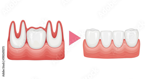 Detailed illustration showcasing the dental bridge procedure, demonstrating how missing teeth are replaced to restore oral health, function, and aesthetics effectively