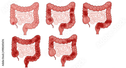 Human colon cancer stages vector set, colorectal disease progression diagrams, medical illustration of intestinal tumors and inflammation