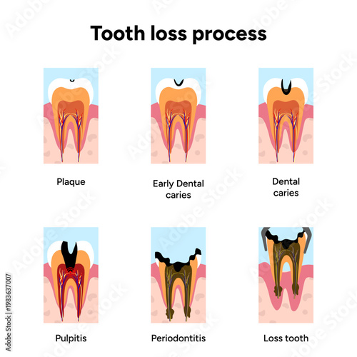 Hand-drawn illustration tooth decay progression from healthy tooth to tooth loss. Educational stages plaque buildup, cavities, enamel damage, infection, and final tooth loss