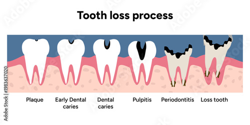 Hand-drawn illustration tooth decay progression from healthy tooth to tooth loss. Educational stages plaque buildup, cavities, enamel damage, infection, and final tooth loss