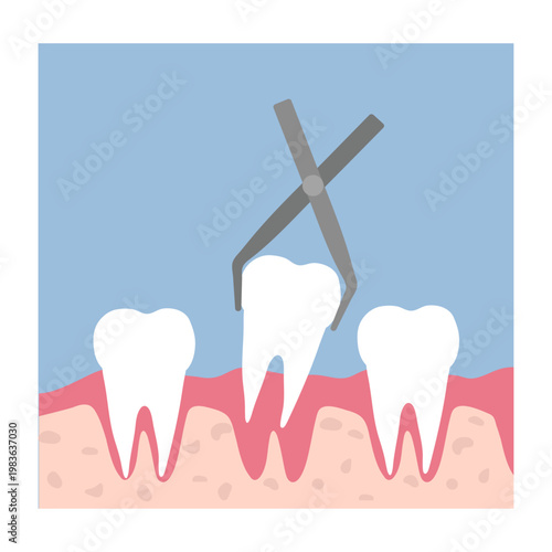 Hand-drawn illustration tooth decay progression from healthy tooth to tooth loss. Educational stages plaque buildup, cavities, enamel damage, infection, and final tooth loss