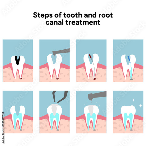 Hand drawn illustration set showing tooth anatomy and step by step dental treatment, including root canal procedure. Educational and detailed composition internal tooth structure, roots, nerve 