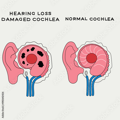 Medical ear comparison diagram vectoring cochlea damage and health
