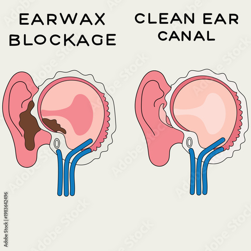 Medical illustration comparing earwax buildup and clear ear canal