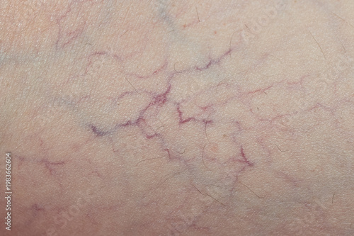 Fotografie A close-up image for medical purposes showing broken capillaries or varicose veins on human skin