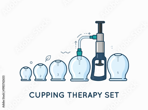 A cupping therapy set with different sized cups and a pump for vacuum creation, illustrating a traditional treatment method.