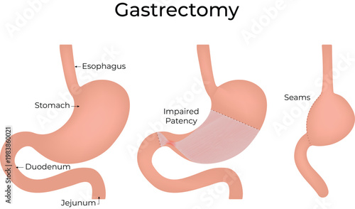 Gastrectomy Surgical Procedure Diagram