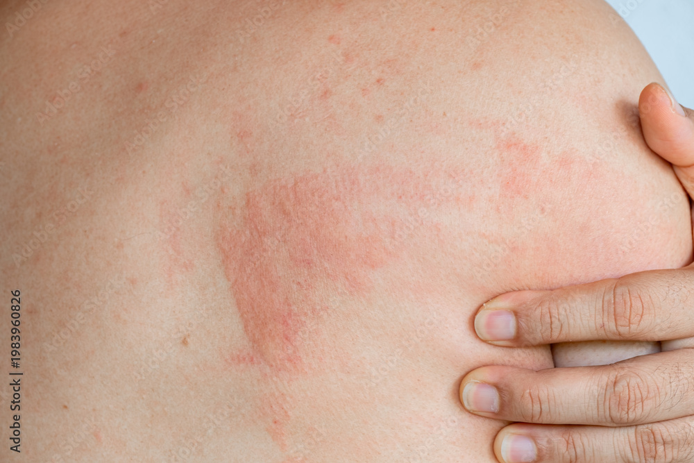 Fototapeta premium Close up of a man with a red skin rash and inflammation on his back. A person scratching an itchy allergic reaction, eczema, or dermatitis on the body. Concept of healthcare and dermatology, urticaria