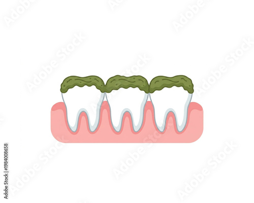 Illustration of unclean teeth with plaque buildup