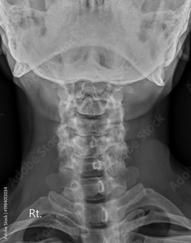 Cervical Spine X-ray Showing Spondylosis and Degenerative Changes in Neck Vertebrae.