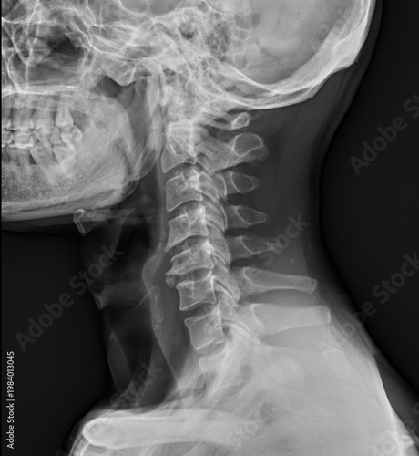 Cervical Spine X-ray Showing Spondylosis and Degenerative Changes in Neck Vertebrae.