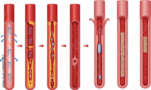 Blood Vessel Treatment Process Illustration with Plaque Removal Stent Placement and Restored Artery Flow Medical Vector Diagram Set