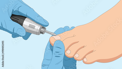 Podiatrist treating a patient toe with a professional medical nail drill machine in a clinical setting for health care needs.