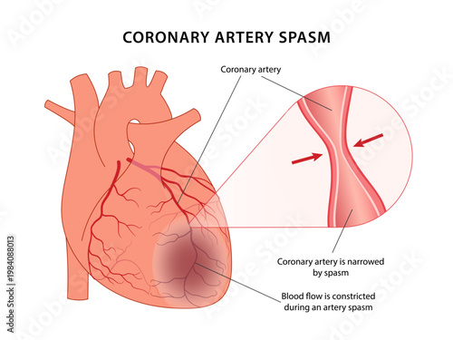 Coronary artery spasm. Medical illustration of coronary artery spasm. Vector illustration in flat style isolated over white background