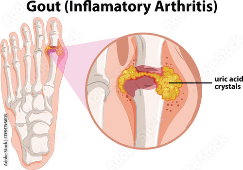 Gout Inflammatory Arthritis with Uric Acid Crystal Buildup in the Foot Joint
