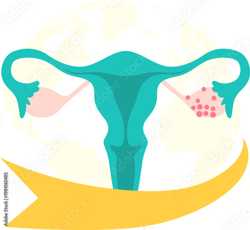 Polycystic Ovary Syndrome Awareness