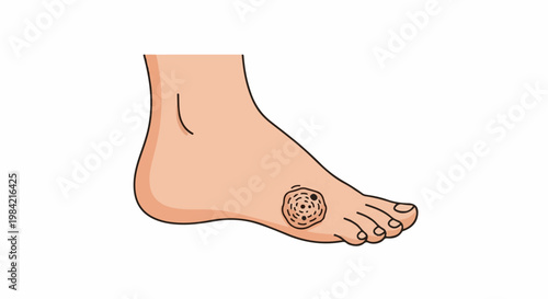 Human foot with a plantar wart on the sole
