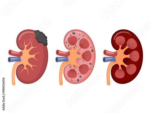 Cross sections of kidneys showing healthy diseased and cancerous conditions medical
