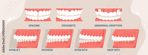 Dental bite types including spacing, crossbite, overjet, reverse, open bite, deep bite, and abnormal eruption shown for orthodontic and dental education vector illustration