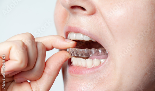 Capa after removal of braces to fix result of treatment