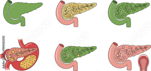 Pancreas Disease Illustration Collection with Healthy and Inflamed Pancreas Conditions Digestive Organ Medical Vector Diagram Set