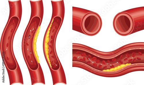 Artery Plaque Buildup Illustration with Healthy and Blocked Blood Vessels Showing Cholesterol Deposits Cardiovascular Disease Medical Vector Diagram Set