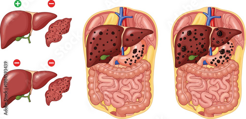 Liver Disease and Fatty Liver Comparison Illustration with Healthy and Damaged Organs Inside Human Body Medical Vector Diagram Set