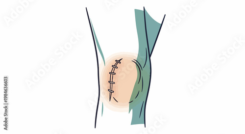 Stylized illustration of a stitched wound on a body part