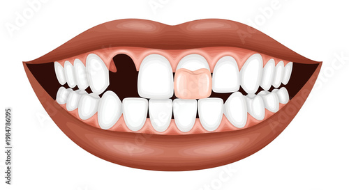dental crown vector illustration, tooth with crown, dental restoration flat design