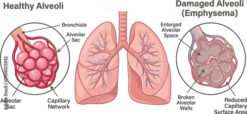 Medical Diagram Comparison of Healthy Alveoli and Damaged Alveoli with Emphysema, Human Lungs Anatomy Flat Vector Illustration