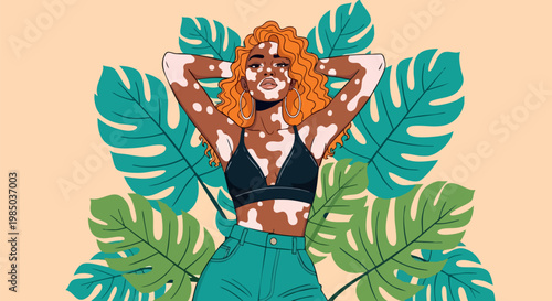 Vitiligo representation vector illustration, beautiful woman with skin pigmentation disorder, tropical monstera leaves and summer aesthetic